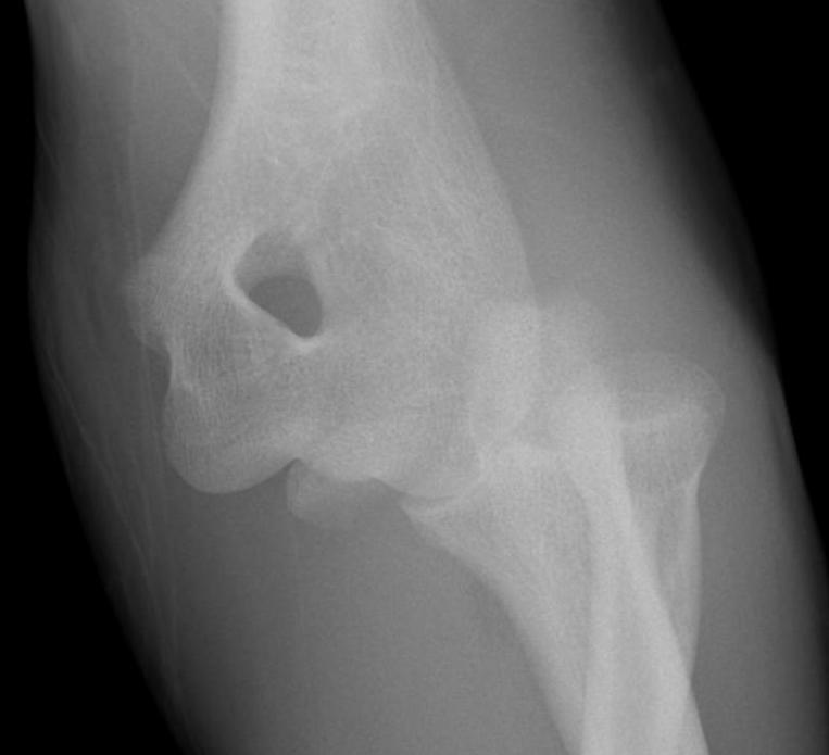 Elbow Dislocation Medial Epicondyle Fracture